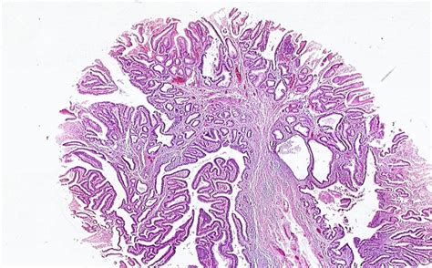 Villous Adenoma Histology