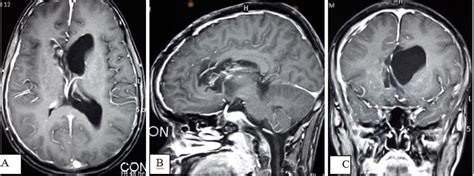 MRI of brain with contrast demonstrates no recurrence of tumor and... | Download Scientific Diagram