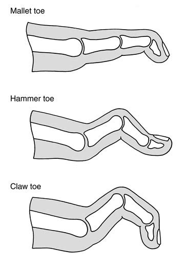 Claw Toe Vs Hammer Toe