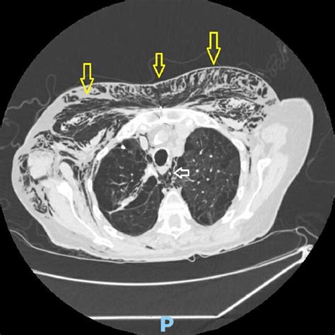 CT chest showing resolution of the pneumothorax. | Download Scientific Diagram