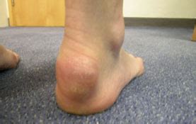 Heel Spur Symptoms - Achilles Tendonitis Symptoms - Health and Fitness Tips