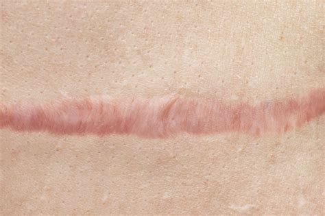 Botulinum Toxin Type A Effective for Treatment of Hypertrophic Scars - Dermatology Advisor