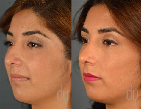 Rhinoplasty | Nose Job Recovery with Rhinoplasty Specialist Dr. Donald ...