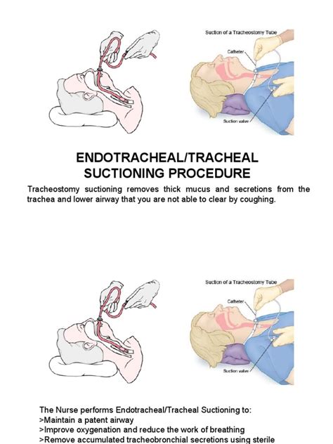 Endotracheal Suctioning Procedure | Clinical Medicine | Respiratory System