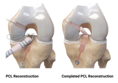 Posterior Cruciate Ligament (PCL) Tears | Dr. Edward S. Chang, MD