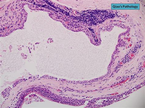 Conjunctival Cyst Histology