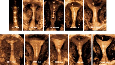 Less menstrual bleeding with a frameless IUD | Dr. Dirk Wildemeersch, MD, PhD