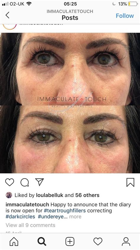 Tear troughs 👍🏻 in 2020 | Tear trough, Plastic surgery, Undereye