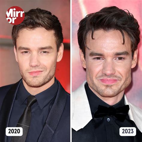 Liam Payne Before And After Jaw Transformation: A Detailed Analysis