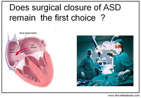 Management of Atrial septal defect : Device closure lagging behind ...