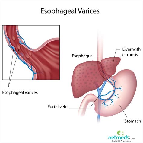 Esophageal Varices: Causes, Symptoms And Treatment | Netmeds