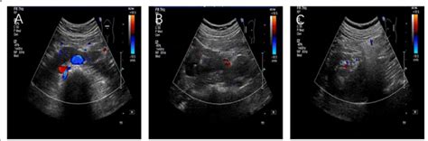 B-mode ultrasonography. A The ultrasound probe is placed on the midline... | Download Scientific ...