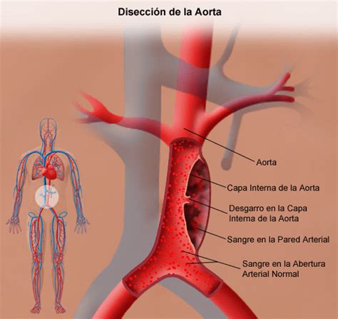 Thoracic Aortic Aneurysm and Aortic Dissection