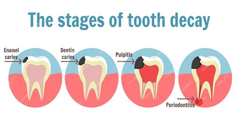 Premium Vector | The stages of tooth decay infographic. Illustration of ...