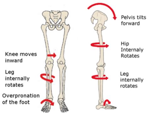 Foot Overpronation From Heel Striking Causes Hip Pain - RUN FOREFOOT