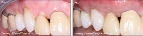 Pinhole Surgical Technique Vancouver Burnaby, Gum Recession Treatment