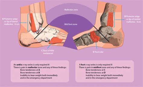 Lateral Ankle Sprain Mechanism Of Injury