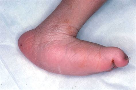 Clubfoot (congenital talipes equinovarus) - Pediatrics - Orthobullets