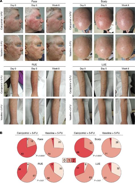 Figure 4 from Randomized trial of calcipotriol combined with 5 ...