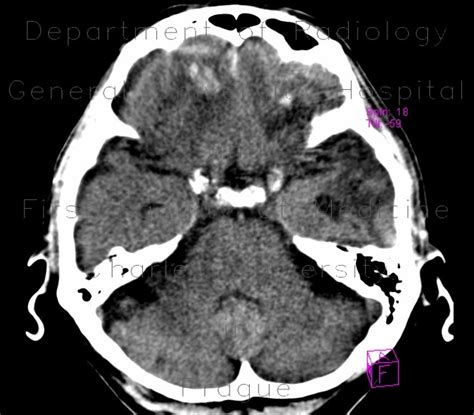 Radiology case: Brain contusion