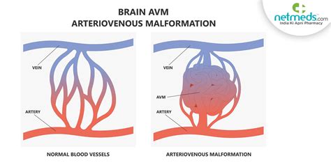 Arteriovenous Malformation (AVM), 59% OFF