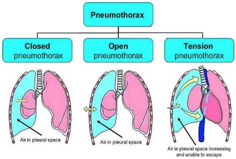 Tension pneumothorax,WHAT TO DO?