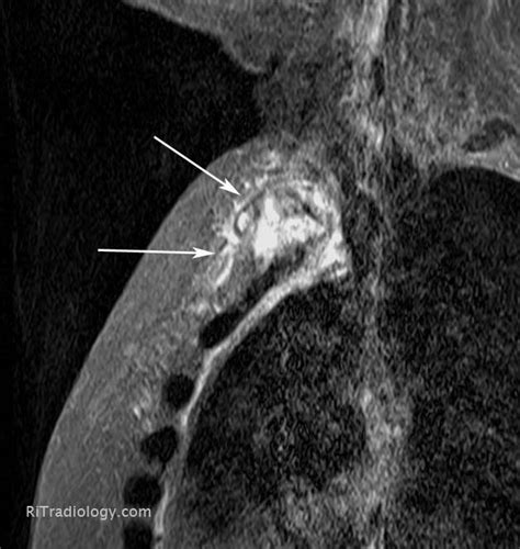 RiT radiology: Sternal Osteomyelitis