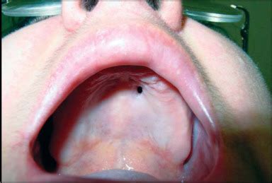 Oronasal fistula in the anterior region of hard palate on the left. | Download Scientific Diagram