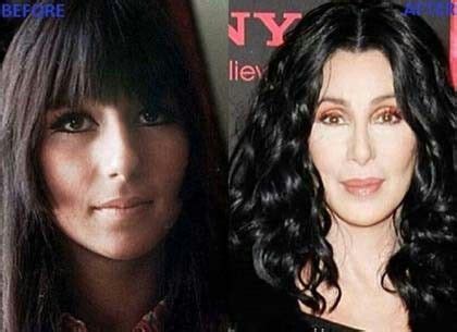 CHER : Before and after plastic surgery | Celebrity plastic surgery ...