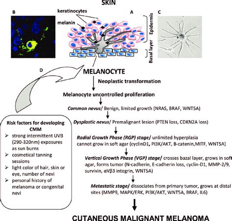 Cutaneous Malignant Melanoma A Schematic Representation Of Epidermal ...