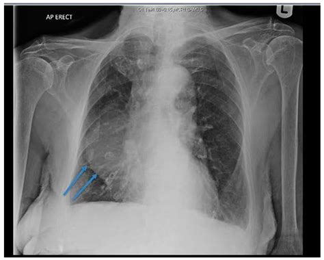 Image Diagnosis: Pericardial Cyst The Permanente Journal, 55% OFF