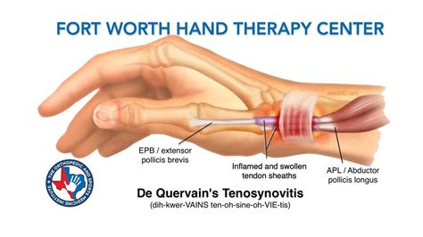 De Quervain’s Tenosynovitis