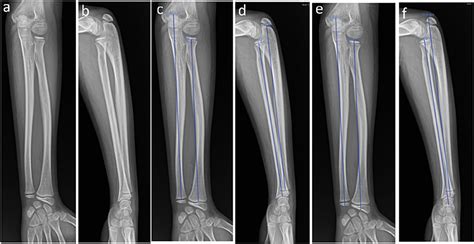 Ulna Bone Xray