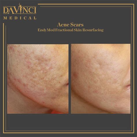 Da Vinci Clinic - Acne Scars Treatment using RF Microneedling