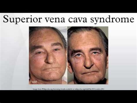 Superior Vena Cava Syndrome Signs Symptoms