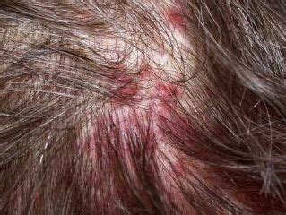 Itchy scalp no dandruff fungal infection | Scalp scabs, Pimples on scalp, Sores on scalp