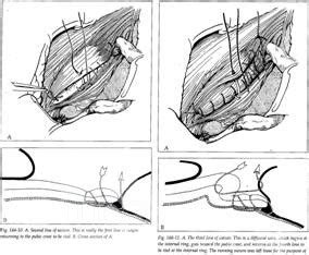 Shouldice Inguinal Hernia Repair • Picture • MEDtube.net