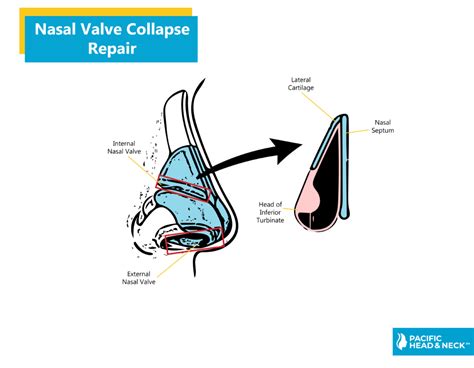 Nasal Valve Collapse Repair - Pacific Eye & Ear Specialists