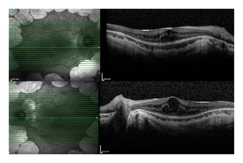 At the time of diagnosis, SD OCT revealed bilateral macular edema in... | Download Scientific ...