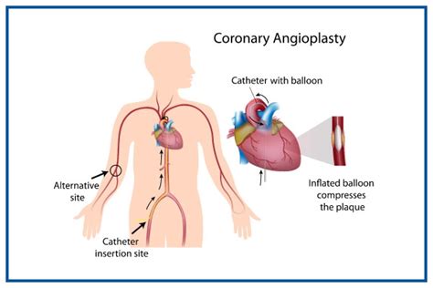 Best Coronary Angioplasty and Stents Insertion Doctors in India