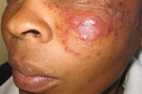 Granulomatous Rosacea (Granulomatous Facial Dermatitis, Lupoid Rosacea)