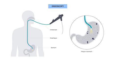 Premium Vector | Gastroscopy procedure Gastroenterologist uses a ...