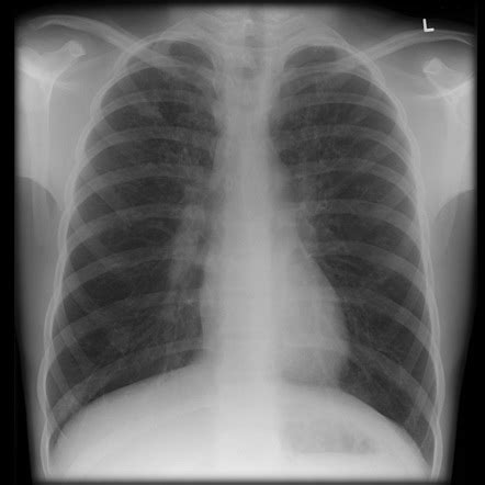 Pulmonary Fibrosis Xray