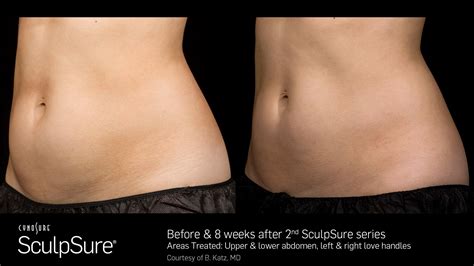 Before & After Pictures of SculpSure « Healthy Living Primary Care – Dr ...