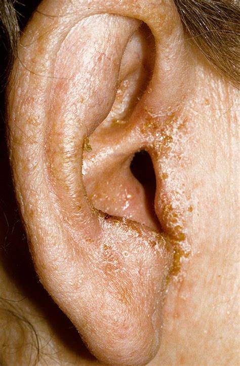 Eczema on the Ears Pictures – 11 Photos & Images / illnessee.com