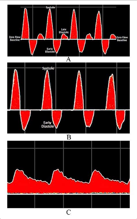 Arterial Waveforms Ultrasound