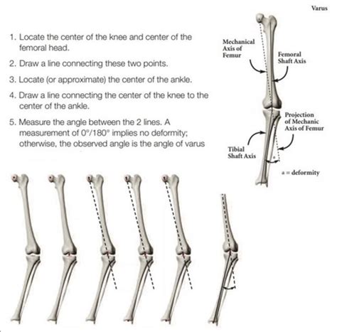 Measurement of Deformity | Download Scientific Diagram