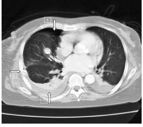 CT-scan demonstrating a small anterior pneumothorax (arrow 1) and... | Download Scientific Diagram