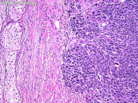 Webpathology.com: A Collection of Surgical Pathology Images