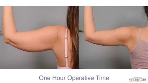 Get Firm, Sculpted Arms With Smartlipo™ | Dr. Sterry Explains - YouTube